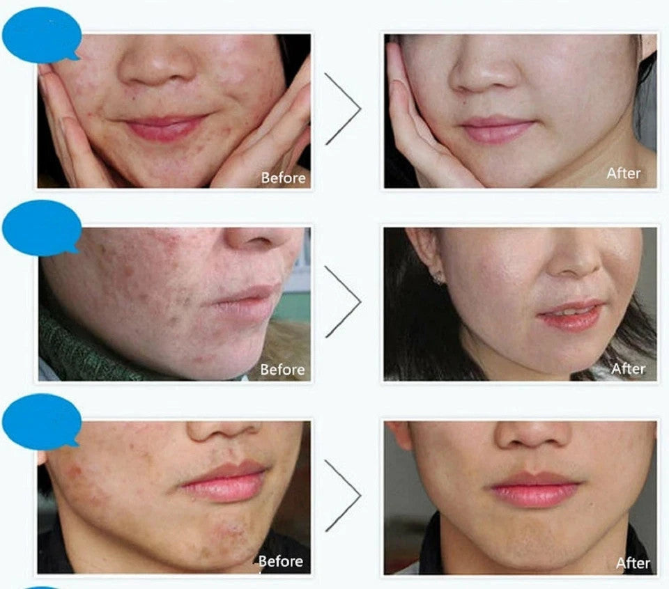 Acne Treatment Cream for Blemishes & Spots - 30ml Face Skin Care