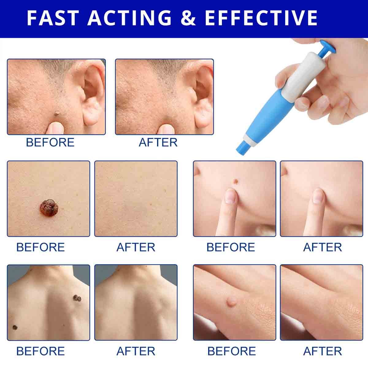 Painless Skin Tag Remover Pen Kit - 2-in-1 Wart & Mole Removal Tool