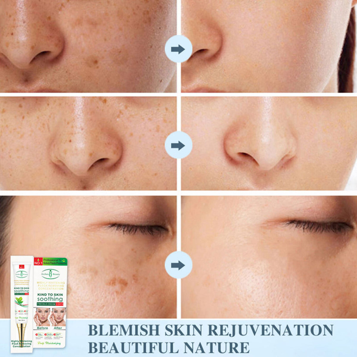 Whitening Freckle Cream for Melasma Acne Dark Spots 30ml - Skin Brightening Serum