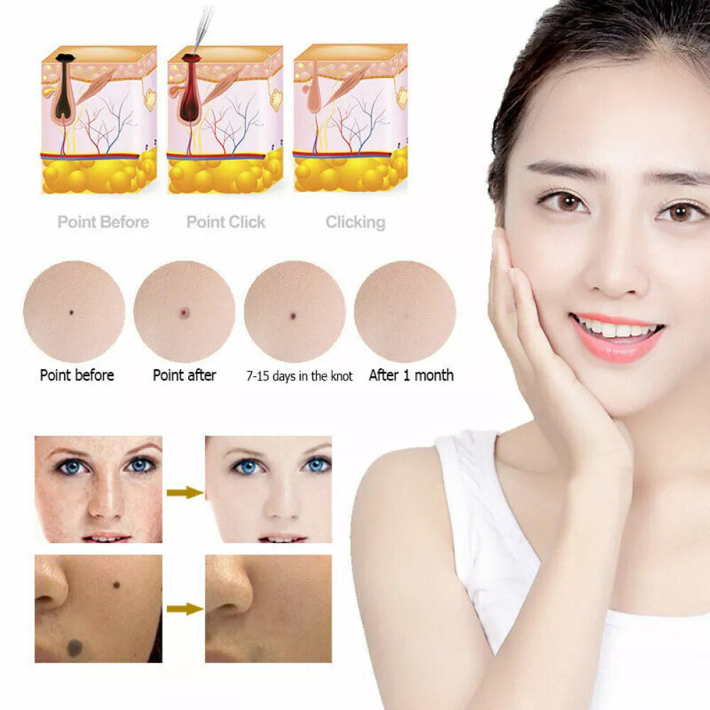Electric Laser Plasma Mole & Skin Tag Removal Pen - Dark Spot Tattoo Remover