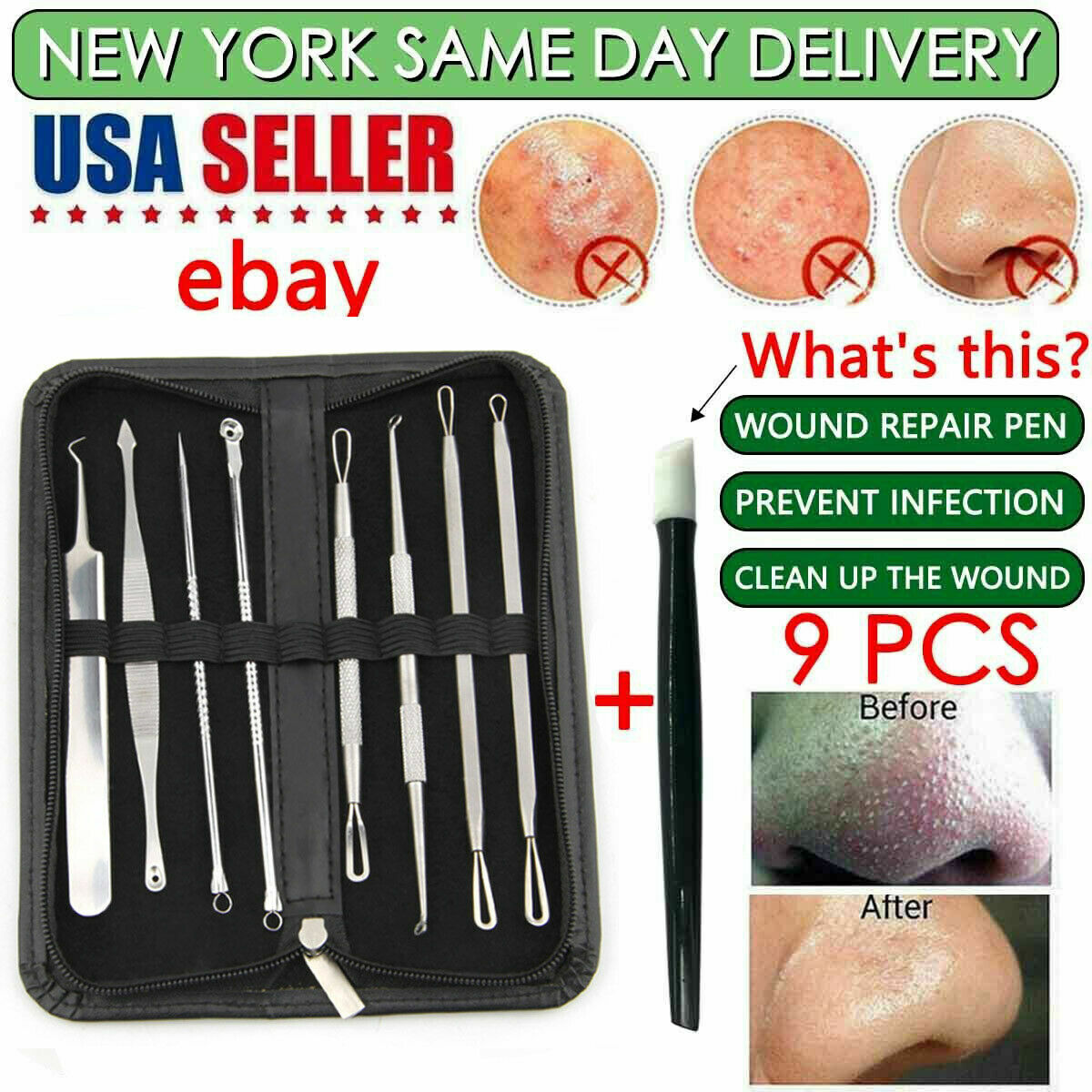 9-Piece Professional Comedone Extractor Acne Removal Kit for Whiteheads and Blackheads