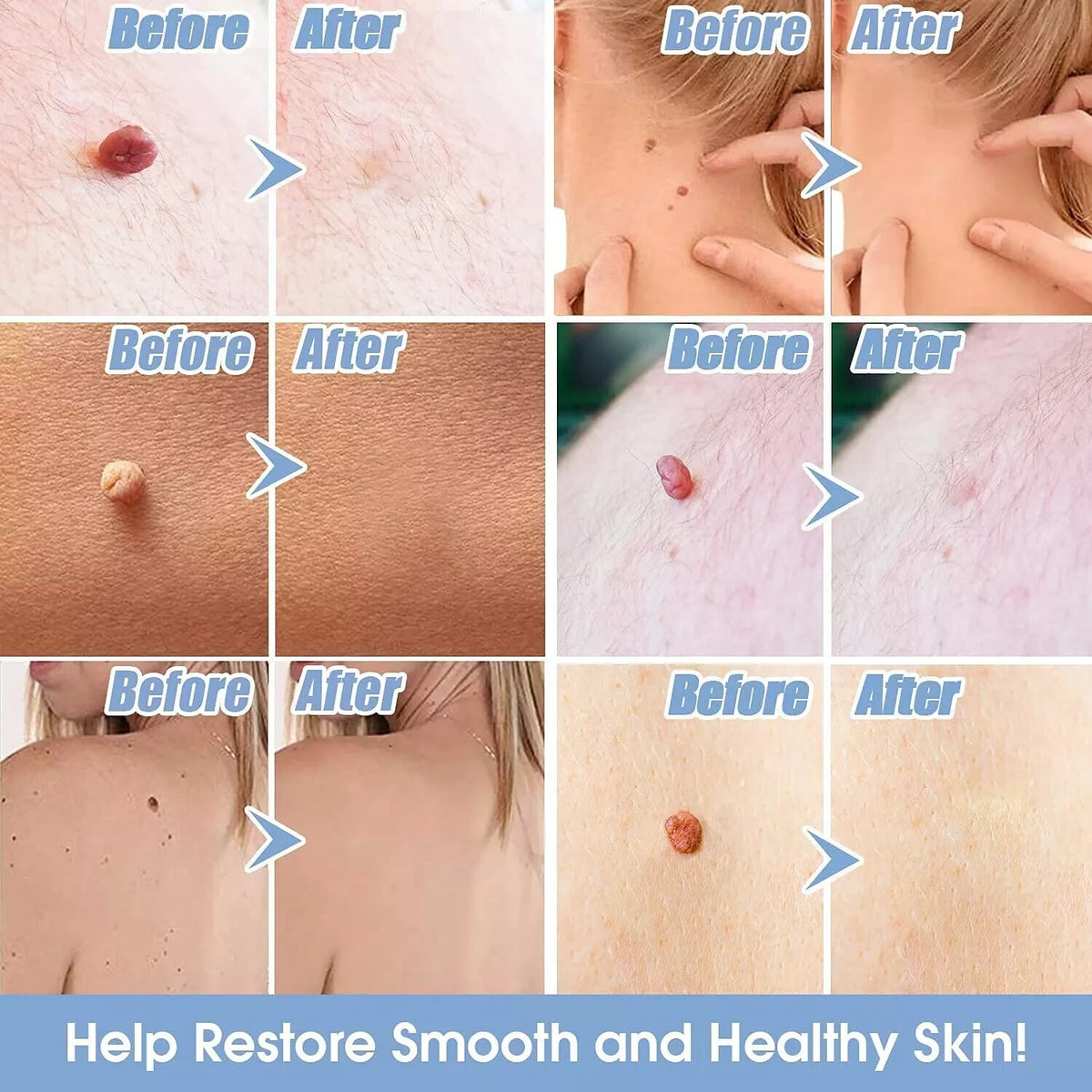 Painless Skin Tag Remover Kit for 1-8mm Moles Acne Wart Removal Set