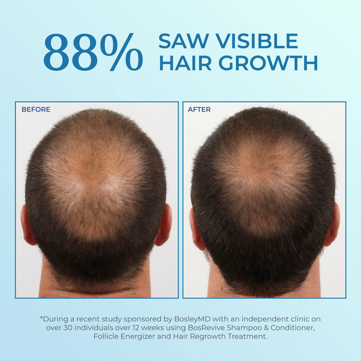 Minoxidil 5% Topical Spray for Men Hair Loss, 2-Pack
