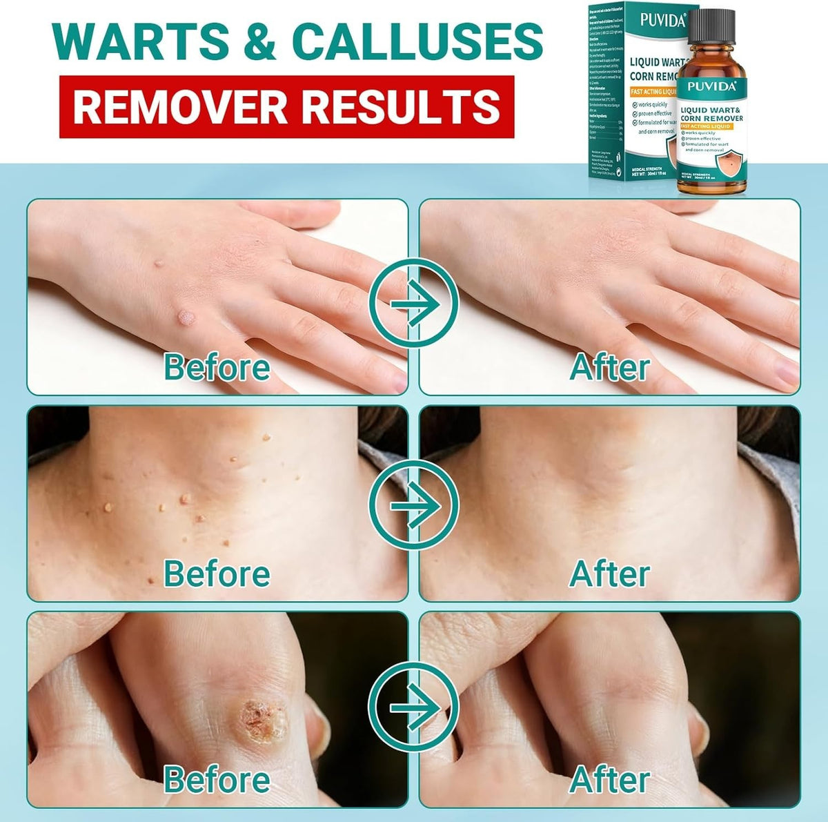 Liquid Wart & Corn Remover - Fast Acting Salicylic Acid Treatment - 1 fl oz