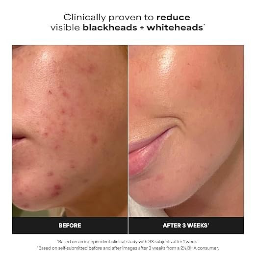 NEW Paula's Choice Skin Perfecting 2% BHA Liquid Exfoliant 118ml