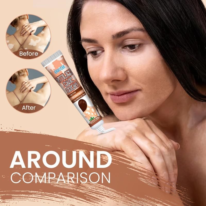 Vitiligo Cream Natural Skin Pigmentation Treatment for White Spots - Safe & Effective
