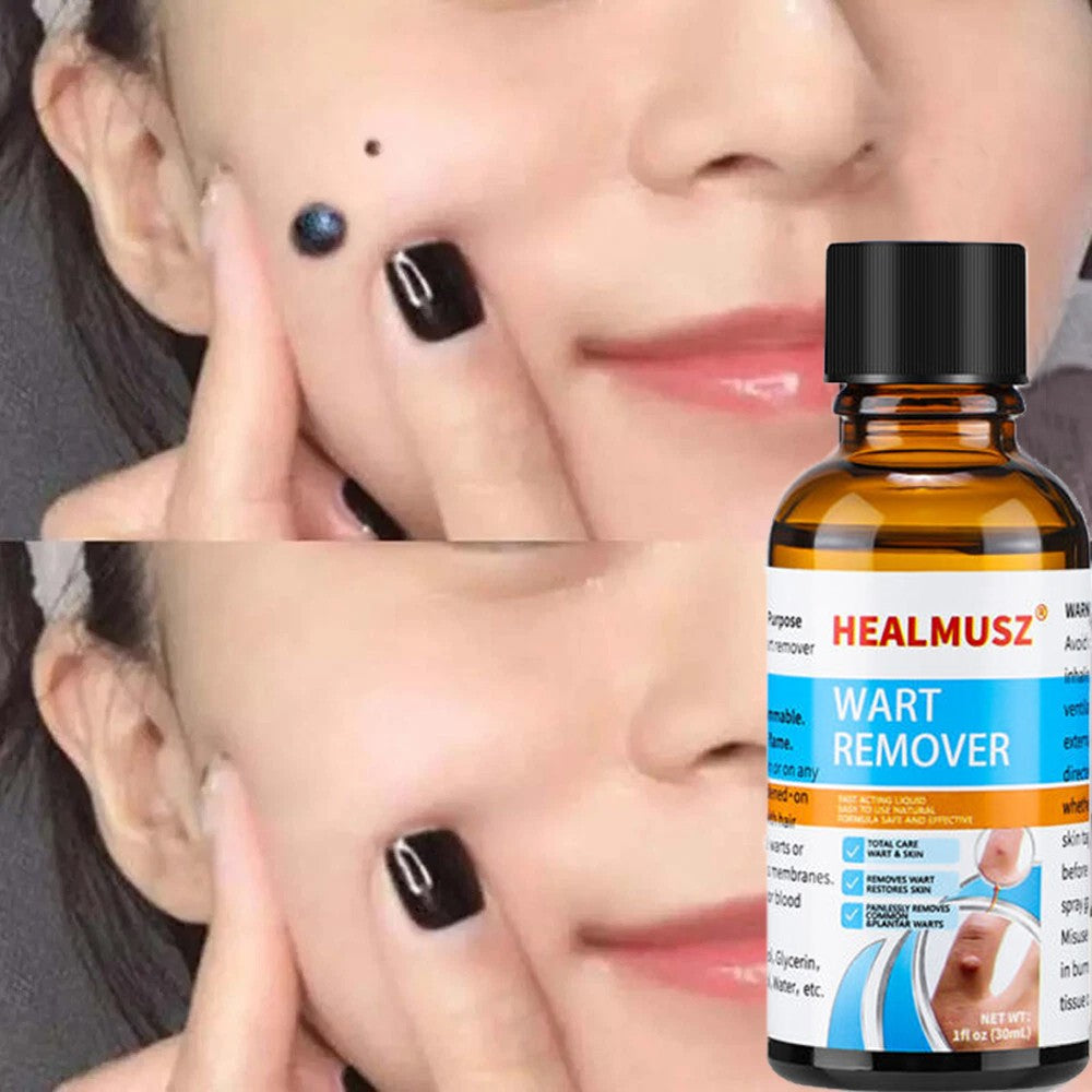 Wart Remover Liquid for Common and Plantar Warts - Fast Acting Treatment
