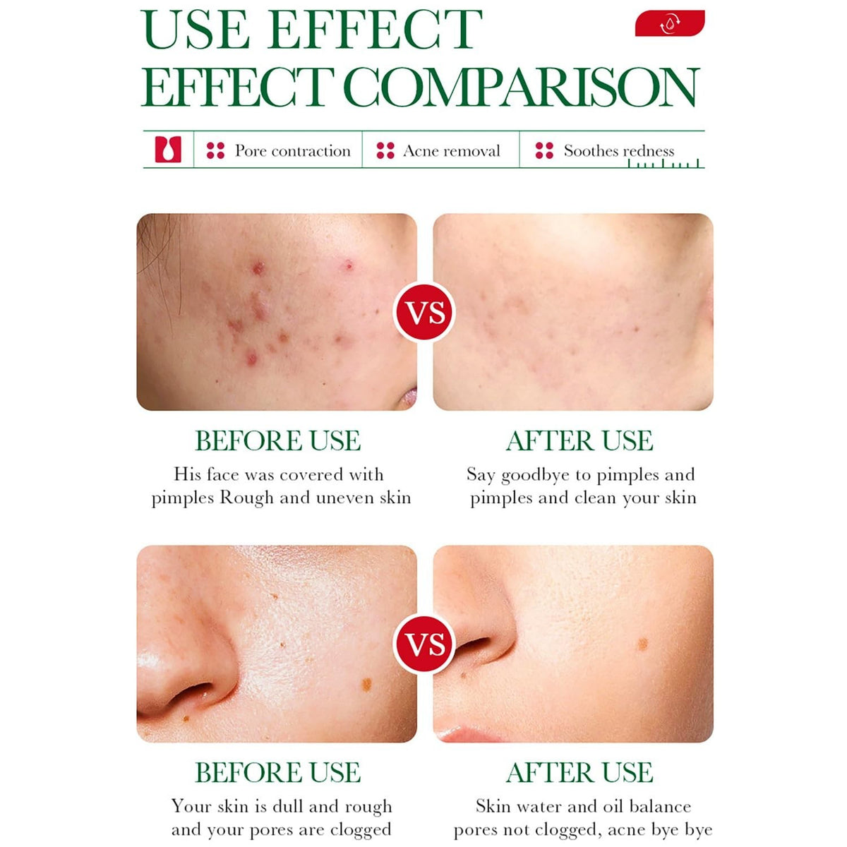 Salicylic Acid Acne Treatment Essence for Pore Shrinking & Mark Fading 35ml