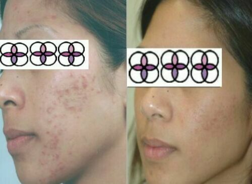 Glycolic Acid Face Cream for Acne and Scar Treatment - 10-70% Strength, 0.4oz