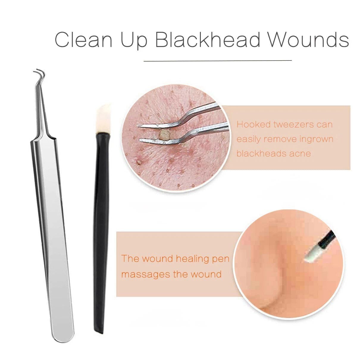 Pimple Popper Kit with Blackhead Extractor Tools - Acne & Zit Removal Set