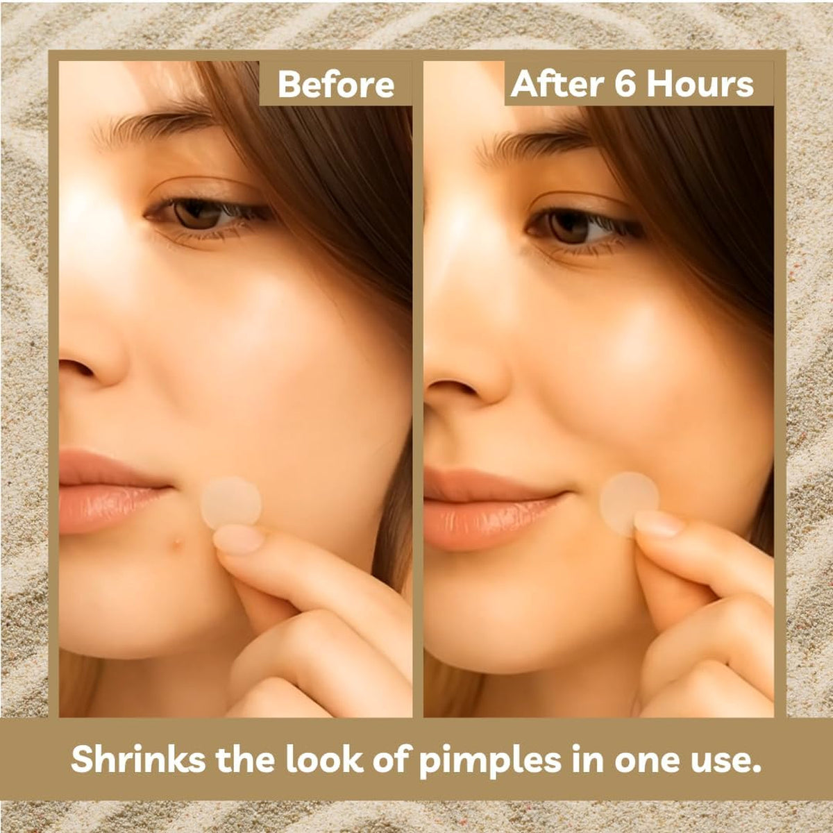 Hydrocolloid Acne Pimple Patches for Face & Skin - 36 Discreet Blemish Stickers