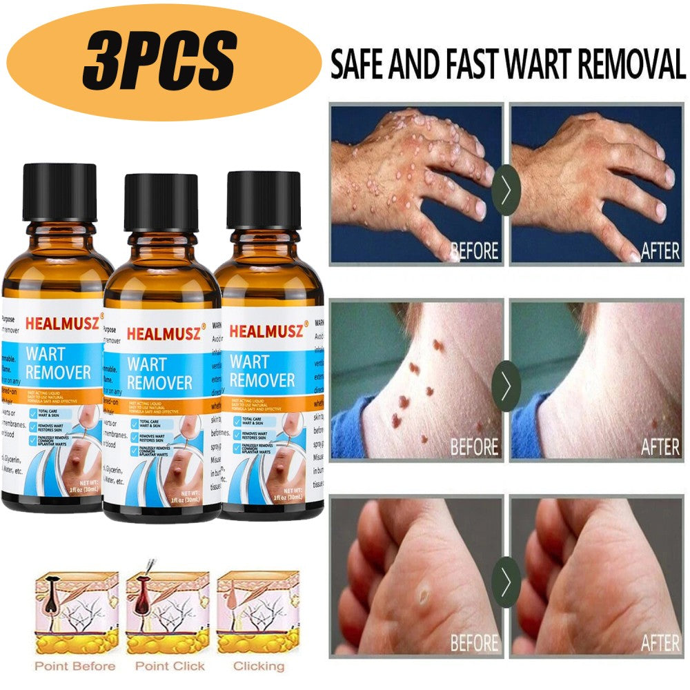 30ml Wart & Skin Tag Remover Liquid - Natural Herbal Formula for Foot & Body Warts
