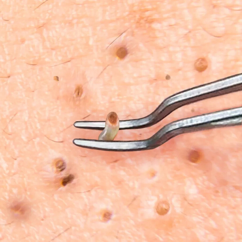 Blackhead Remover Tweezers - Curved Pimple & Acne Extraction Tool