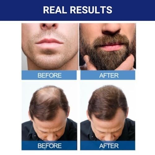 Minoxidil 5% Topical Solution for Men - 6 Month Hair Regrowth