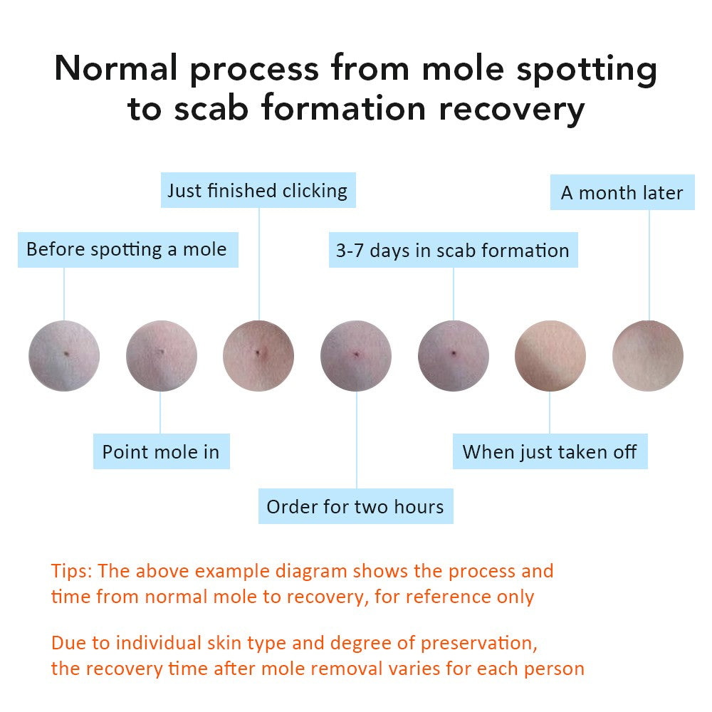 Laser Mole & Skin Spot Remover Pen - Dark Spot, Wart, Tattoo, Freckle Treatment