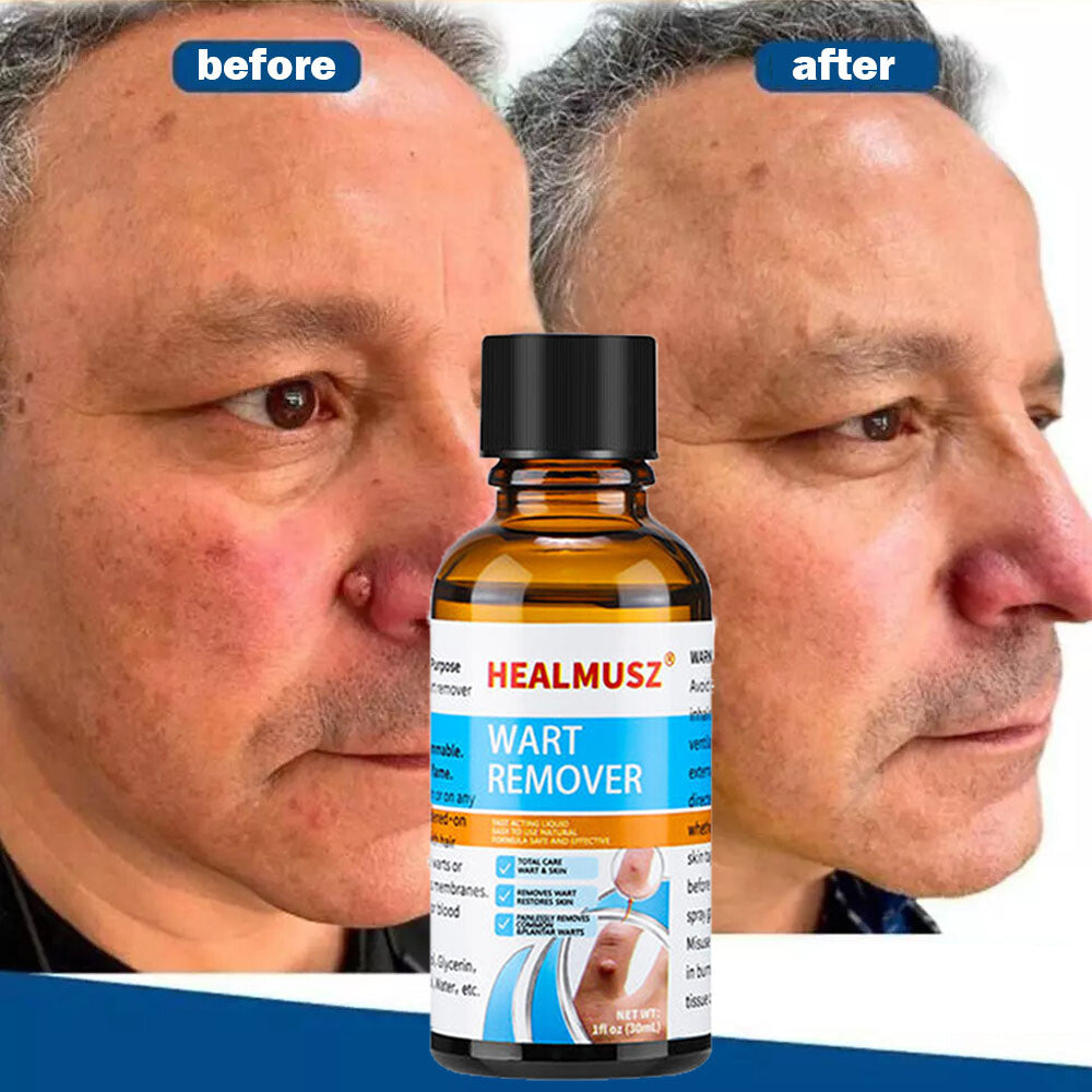 Herbal Wart Remover Liquid for Face Hands & Body - Fast & Painless