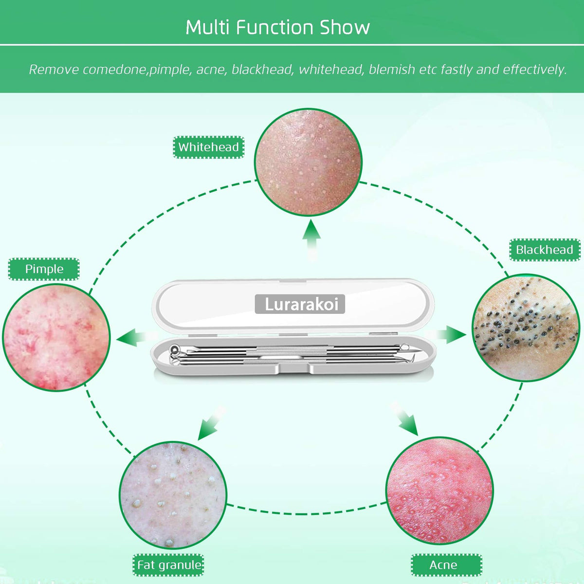 Blackhead Remover Comedone Extractor Set - 5PCS Skin Pore Tool Kit