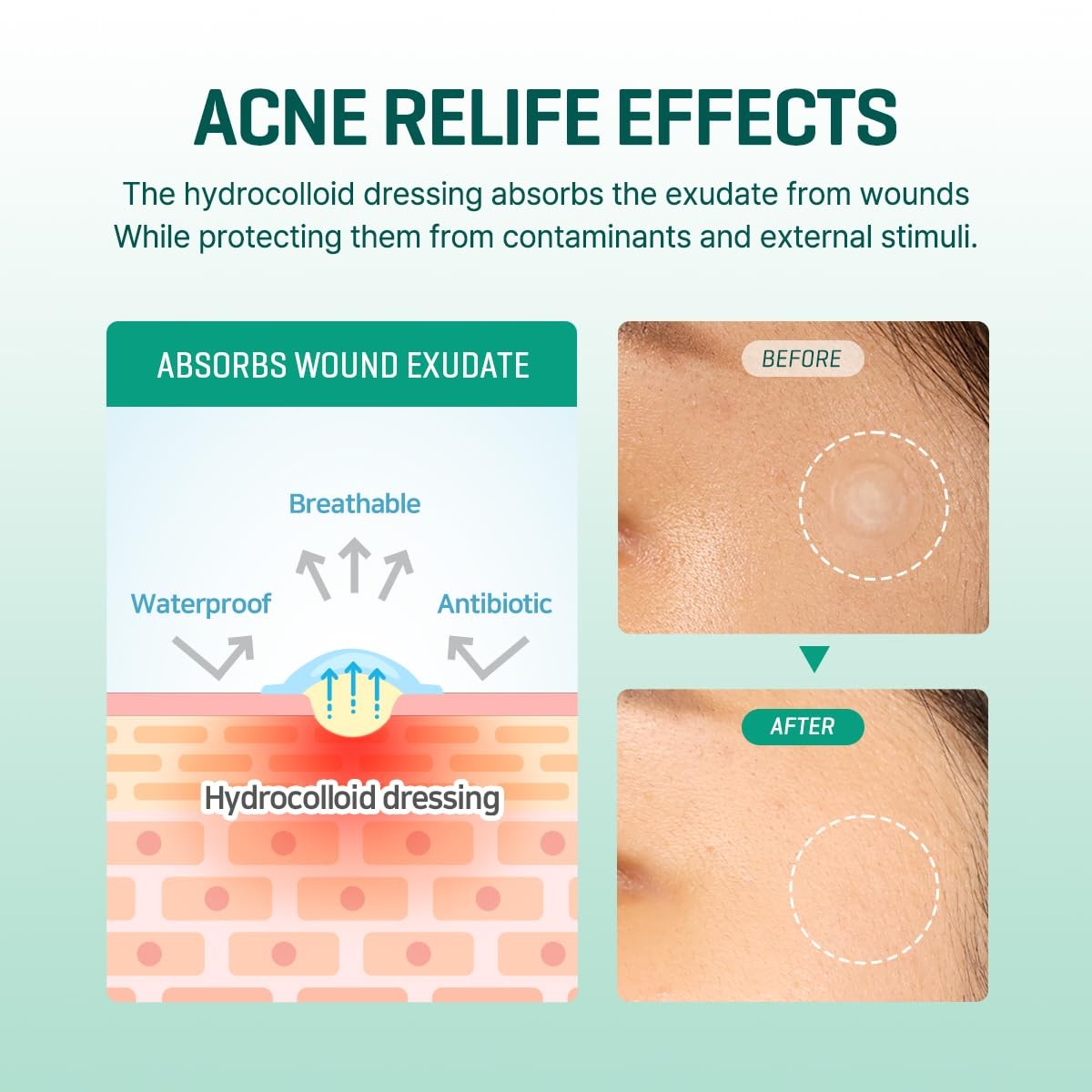 Hydrocolloid Acne Spot Patches - Clear, 90 Count, Invisible for Skin Healing
