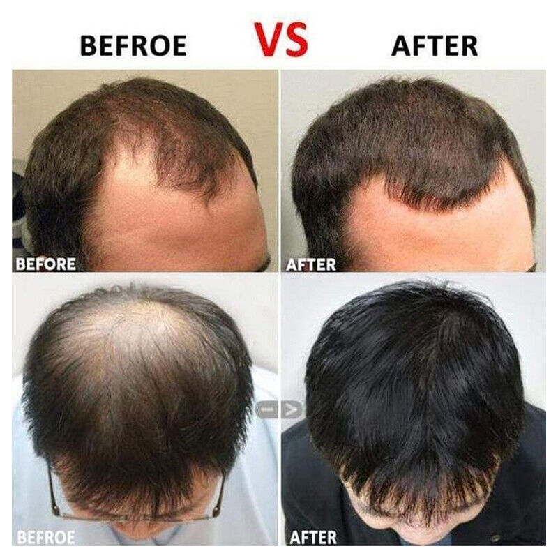 Hair Growth Herbal Supplement Pills 5000mg - Fast Results
