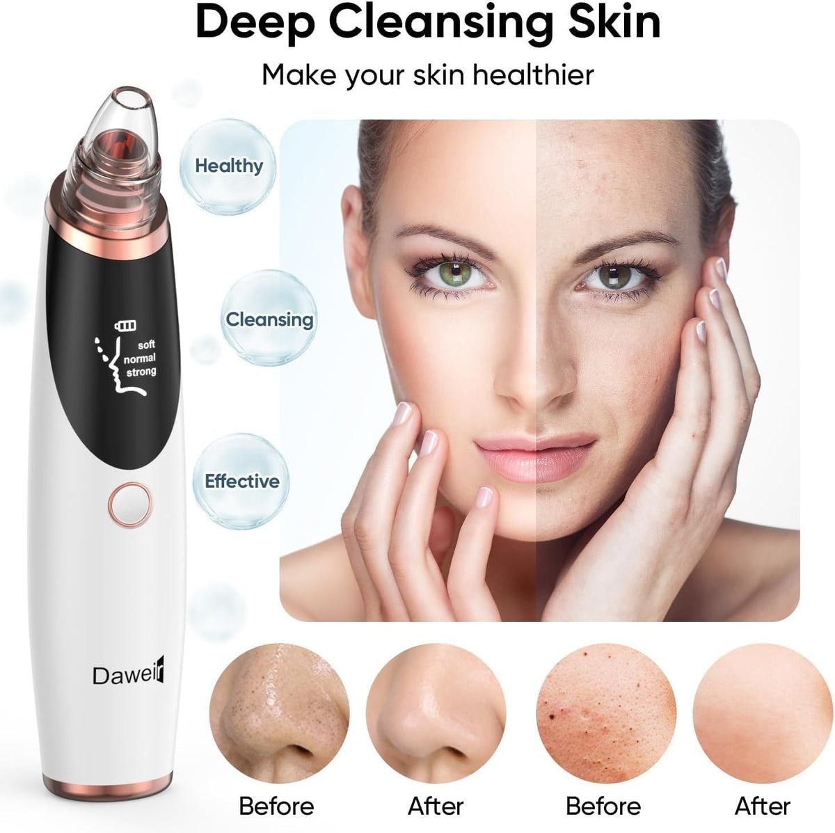 Blackhead Remover Vacuum Pore Cleaner with 3 Suction Levels & 5 Tips
