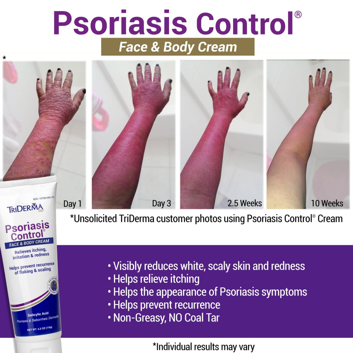 Psoriasis Control Cream 8 oz Maximum Strength Relief