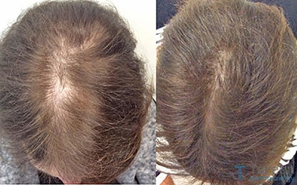 Hair Loss ReGrowth Treatment Oil with 16 Organic Oils