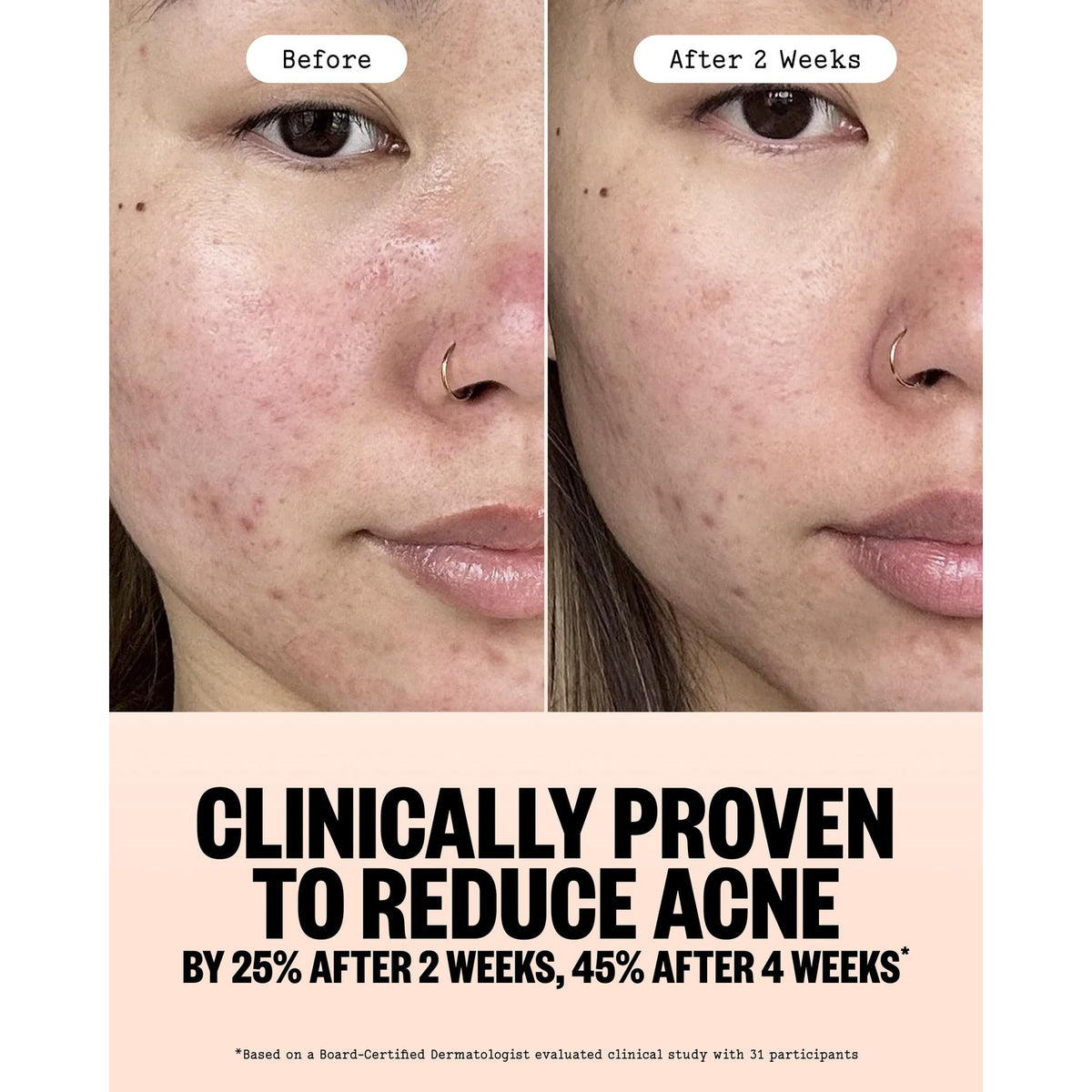 Acne Gel Cleanser with Salicylic Acid for Breakouts and Blemishes - Gentle Daily Face & Body Wash