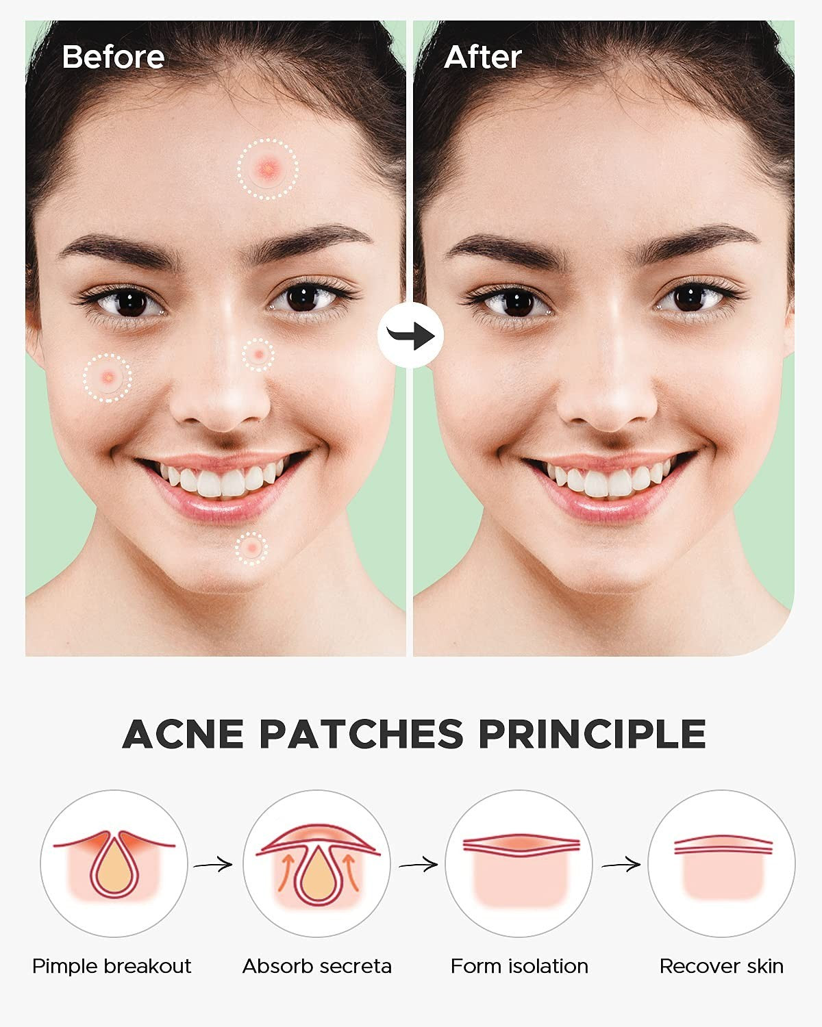 Hydrocolloid Pimple Patches with Tea Tree & Calendula Oil - 180 Count