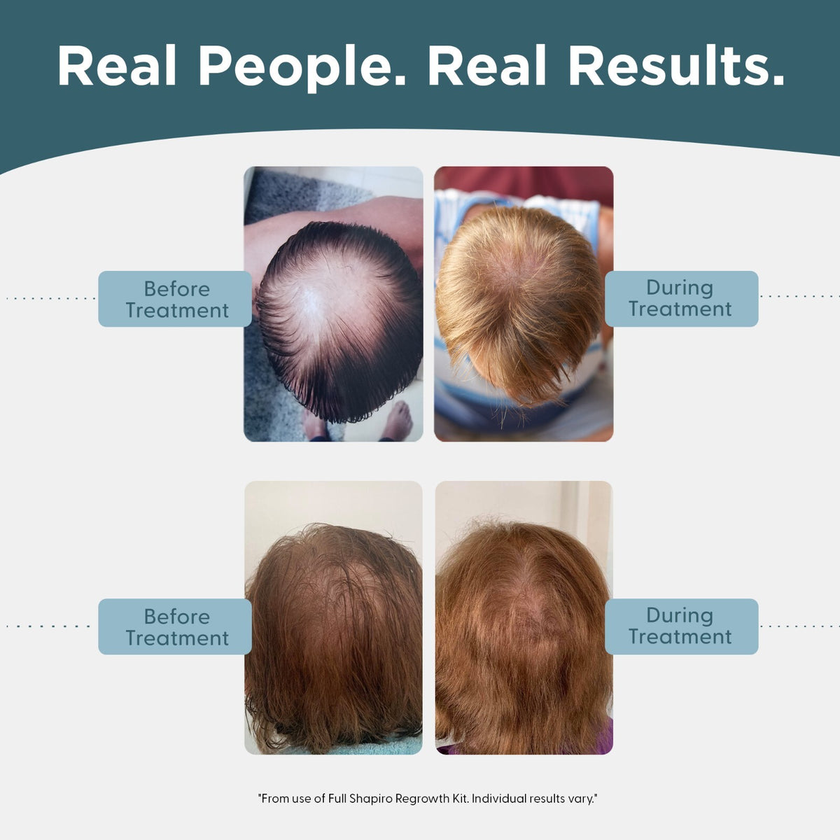 Men's Hair Regrowth Kit - 5% Minoxidil Foam & Serum