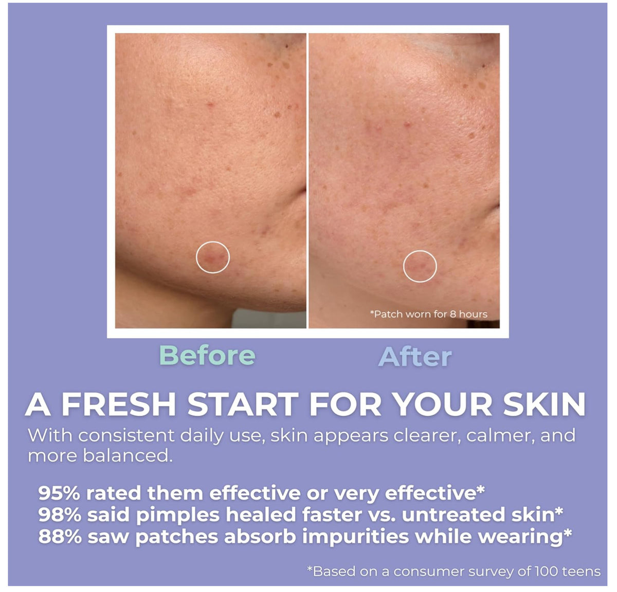 Teen Pimple Patches with Mānuka Oil & Niacinamide - 48 Clear Hydrocolloid Spots