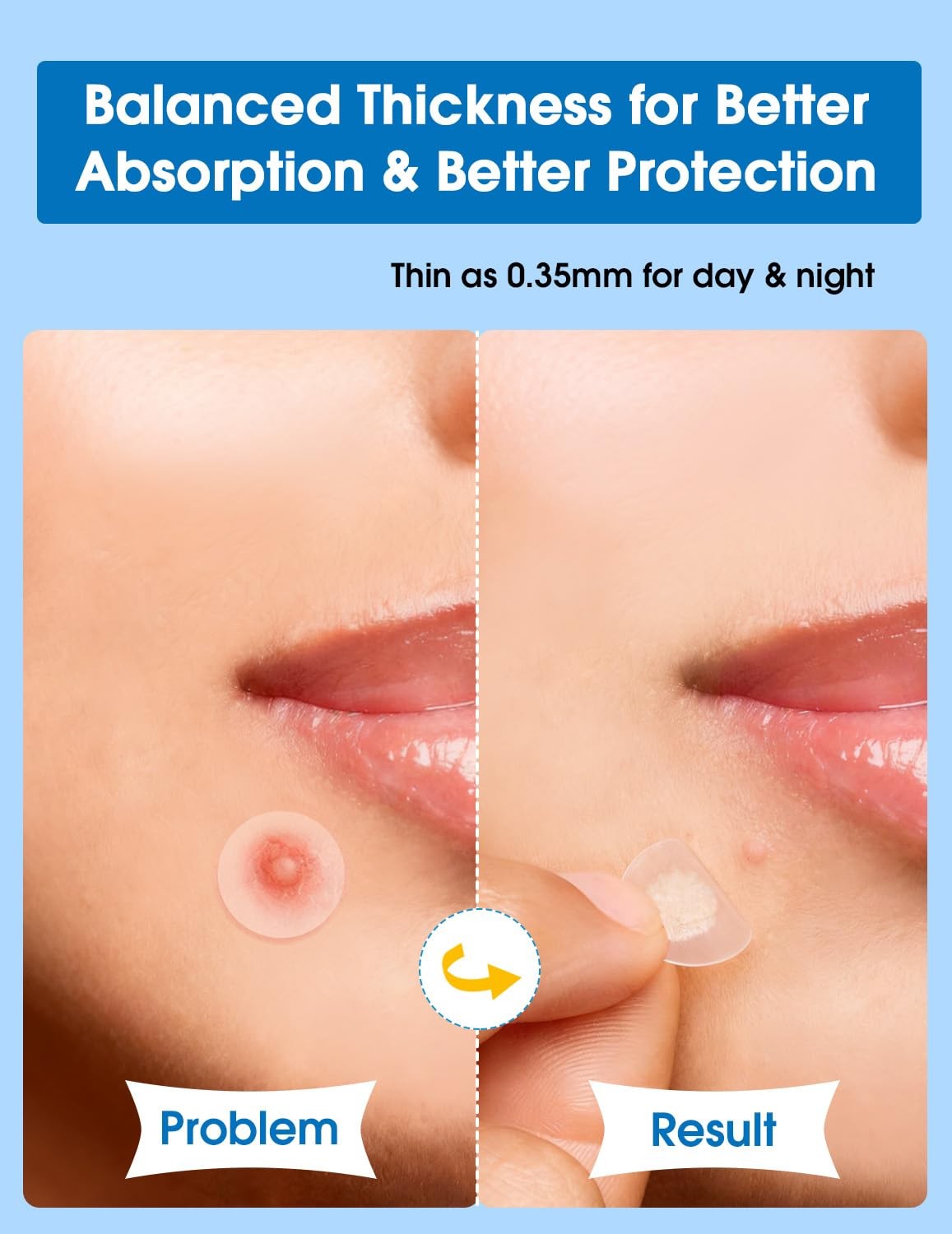 560 Pimple Patches for Face - 6 Sizes, Hydrocolloid Acne Treatment