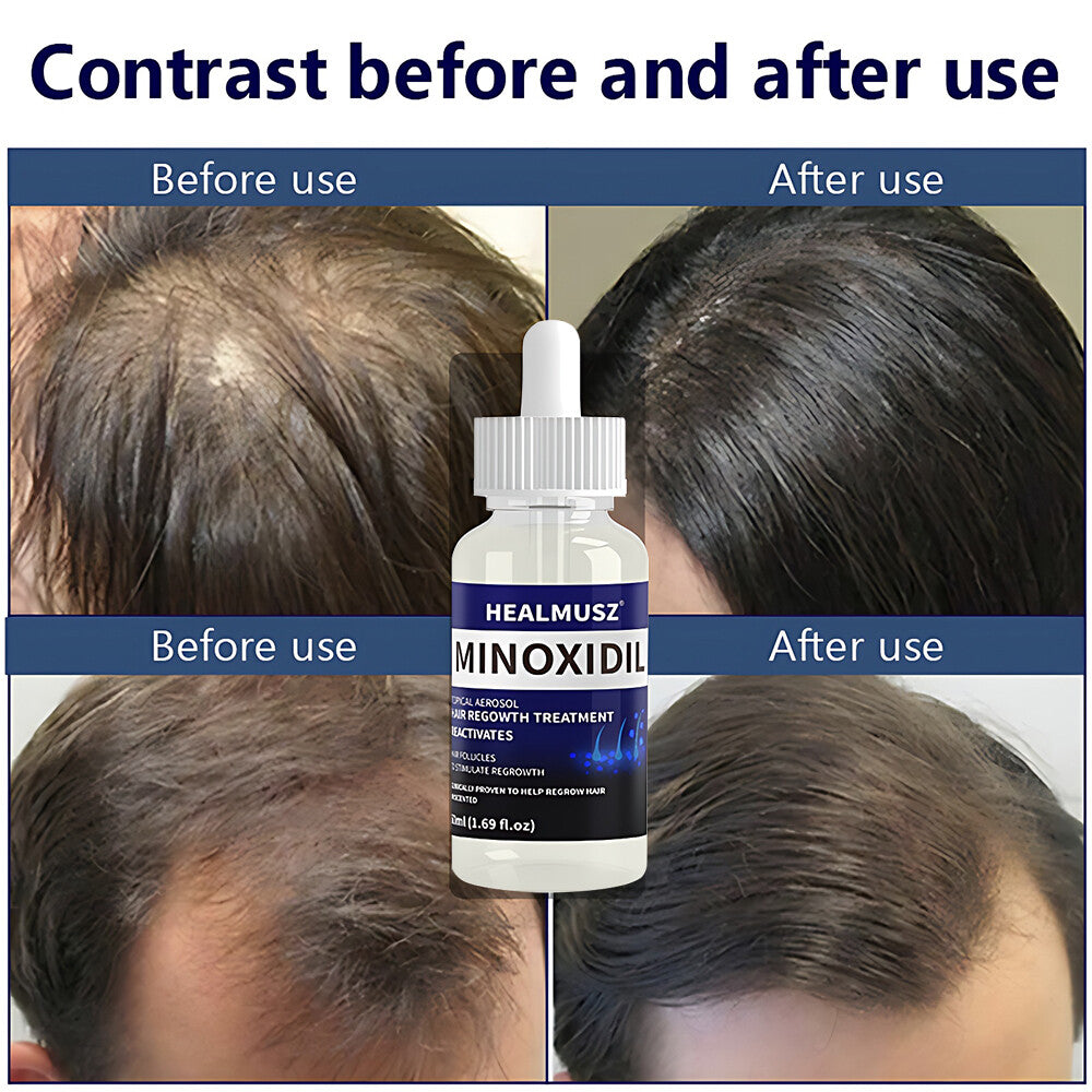 Minoxidil 5% Hair Regrowth Treatment for Men - 6 Pack (300ml)