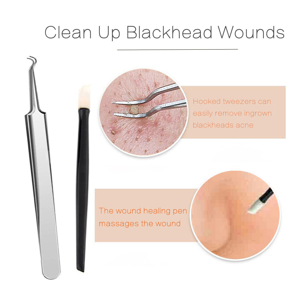 Blackhead Acne Extractor Tool Kit - Pimple Blemish Remover Set with 9 pcs