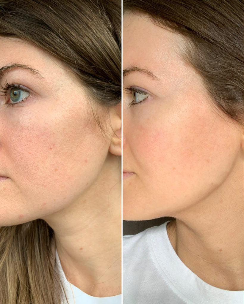 Pure Retinol Vitamin A Serum with Hyaluronic Acid - Anti-Aging Skin Care