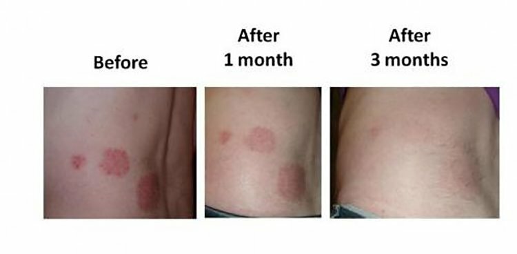 Intense Treatment Cream for Eczema, Psoriasis & Rosacea