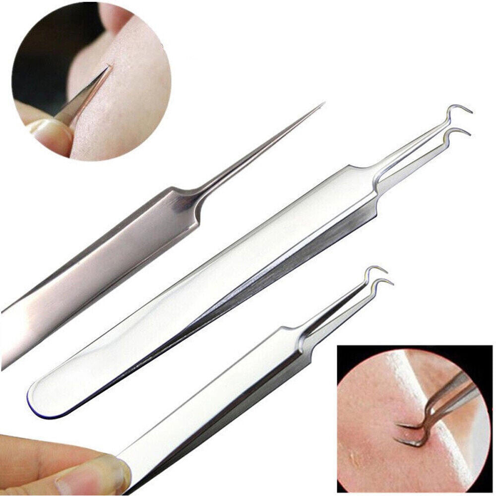 Blackhead Remover Tweezers Set - Pimple Blemish Extraction Tools