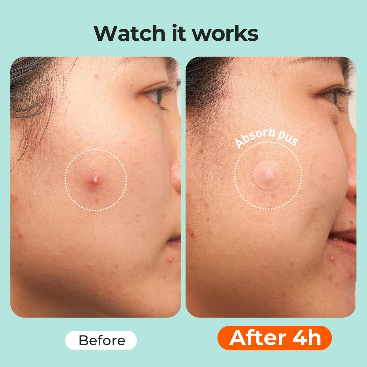 Hydrocolloid Acne Patches, 443 Count Variety Pack - 5 Sizes