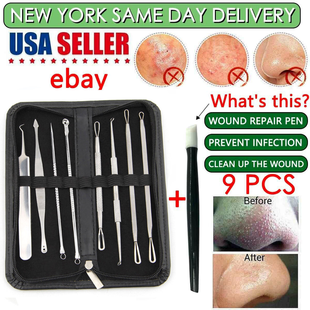 10PC Blackhead & Pimple Extractor Kit - Skin Care Tools for Acne
