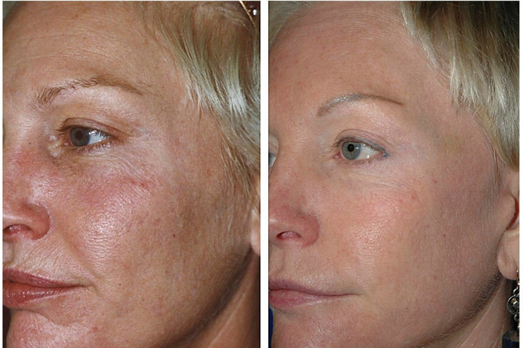 Anti-Aging Skin Care Kit for Mature Skin - Cleanser, Serum, Toner & Moisturizer