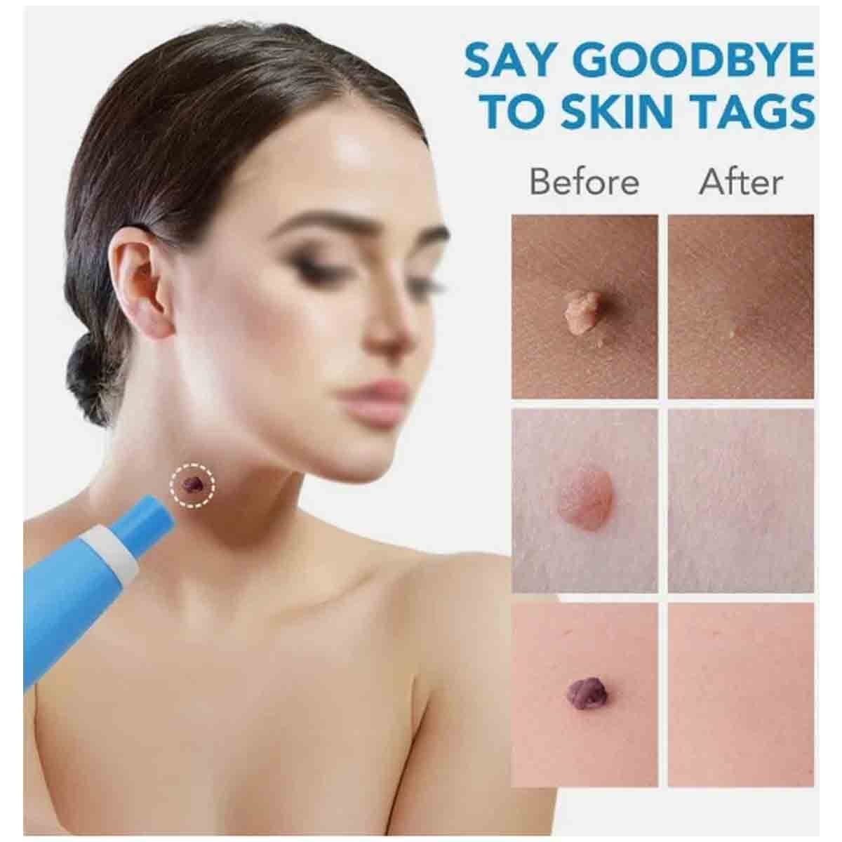 Painless Skin Tag Remover Pen Kit - 2-in-1 Wart & Mole Removal Tool