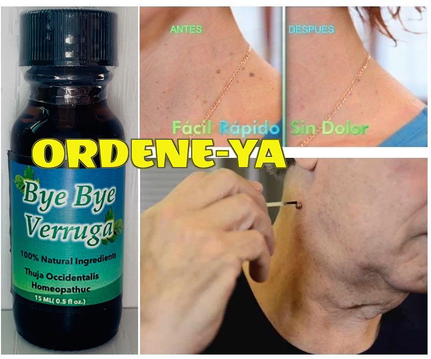 Natural Wart Remover with Thuja Occidentalis