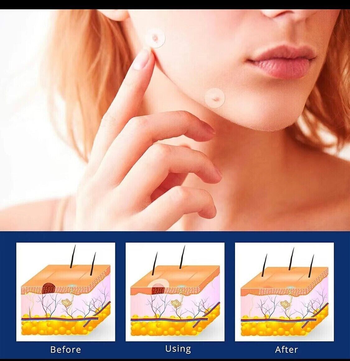 Skin Tag Remover Patches - 144 Effective Mole and Wart Removal Stickers