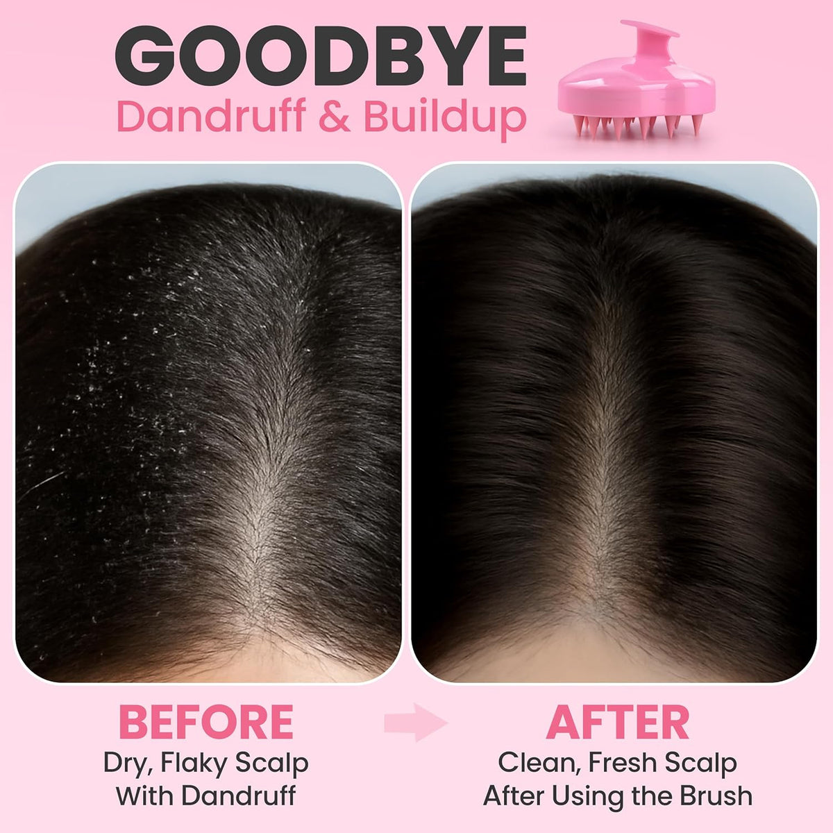 Scalp Massager Hair Growth – Exfoliator & Scrubber for Scalp, Soft