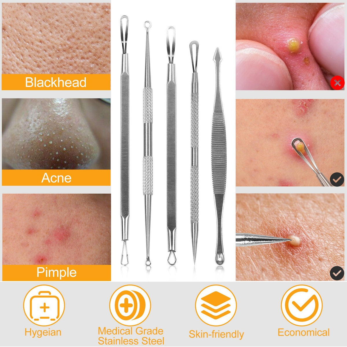 Blackhead Remover Kit 5 Pcs Facial Pimple Extractor Tools Set