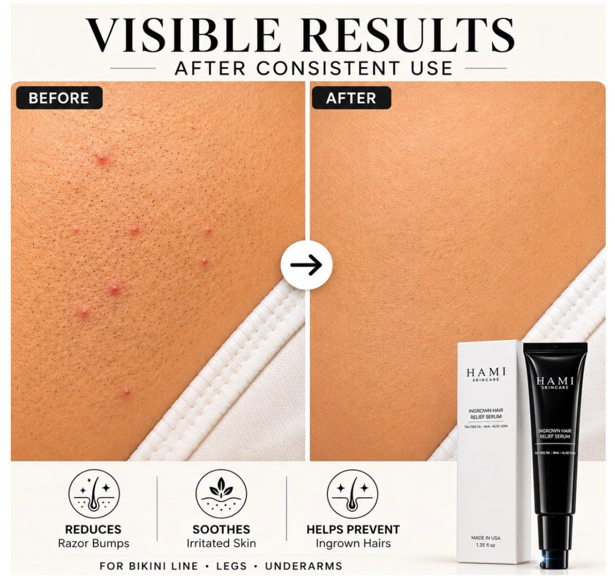 Ingrown Hair Serum for Bikini Line & Razor Bump Treatment - Smooth Skin