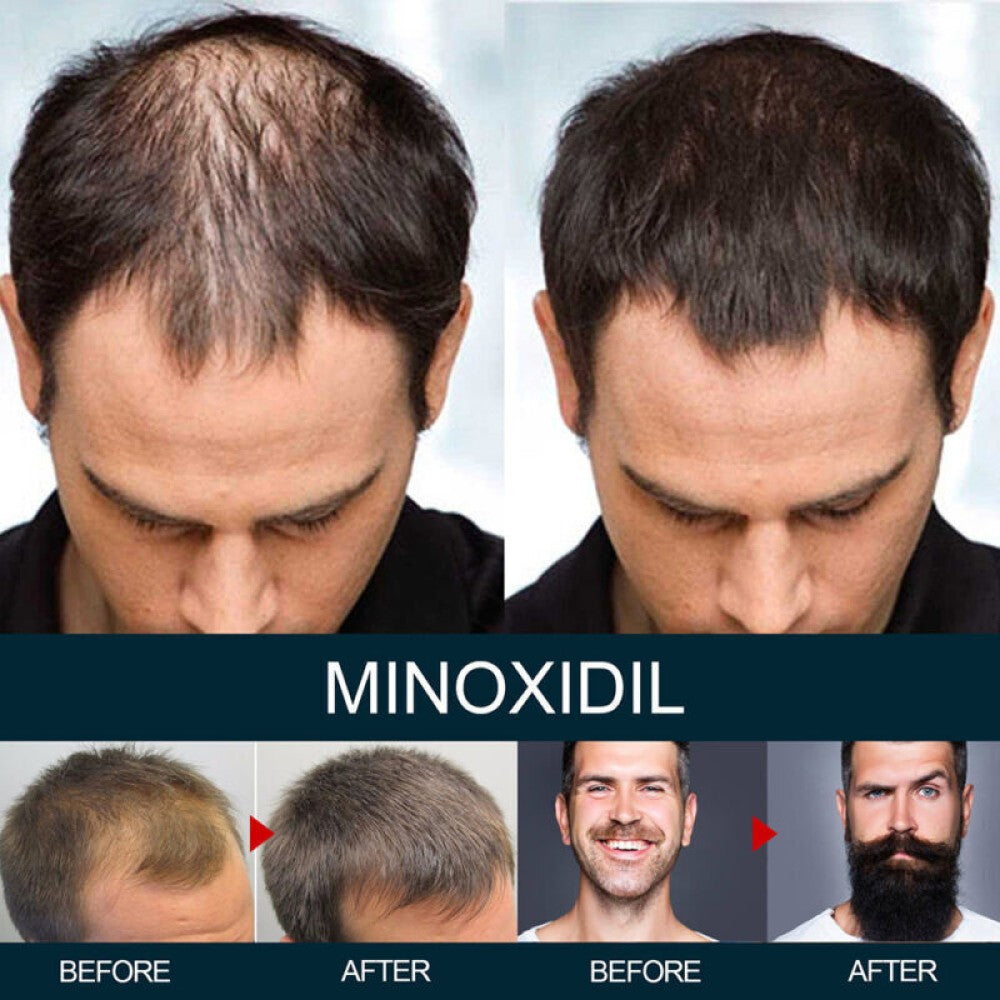 Minoxidil 5% Spray Men Hair Regrowth Treatment Solution 1 Month