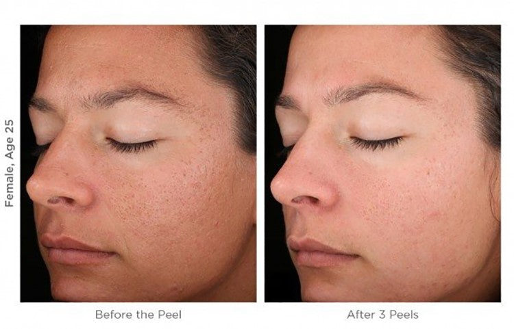 MicroDermabrasion AHA Cream Exfoliant Resurfacing Scrub -Anti Aging
