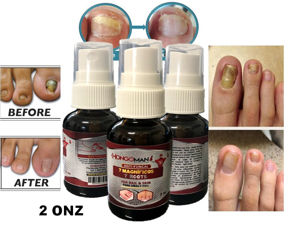 Natural Anti-Fungal Nail Support Kit for Fungus Clear Nails 2oz Spray & Brush