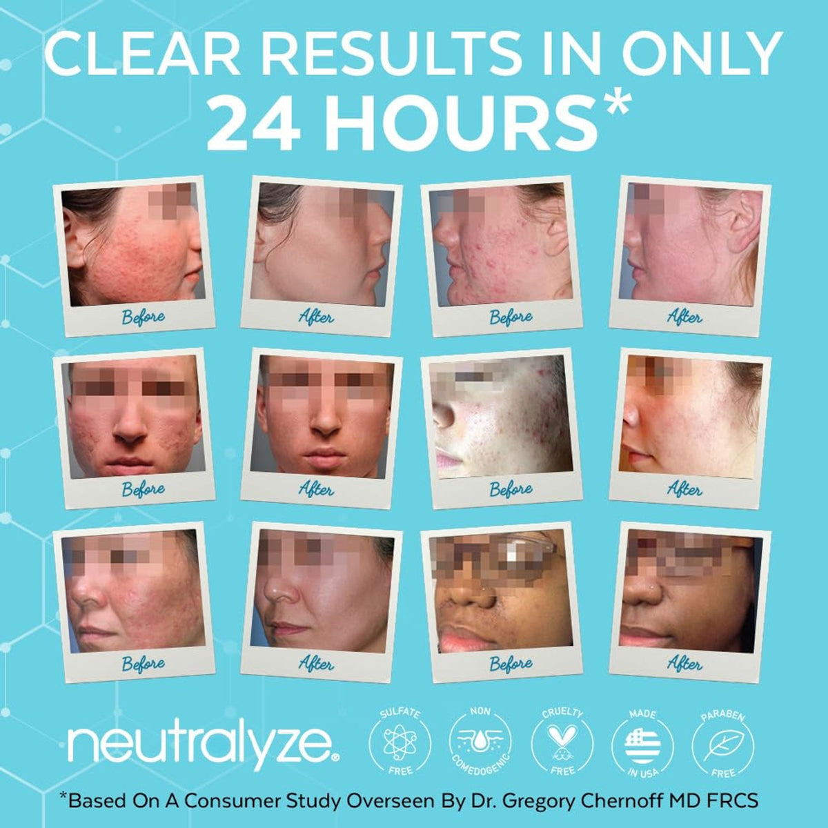 Maximum Strength Acne Treatment Kit with Salicylic & Mandelic Acid - 3 Step System for Face, Dark Spots & Skin Clarity