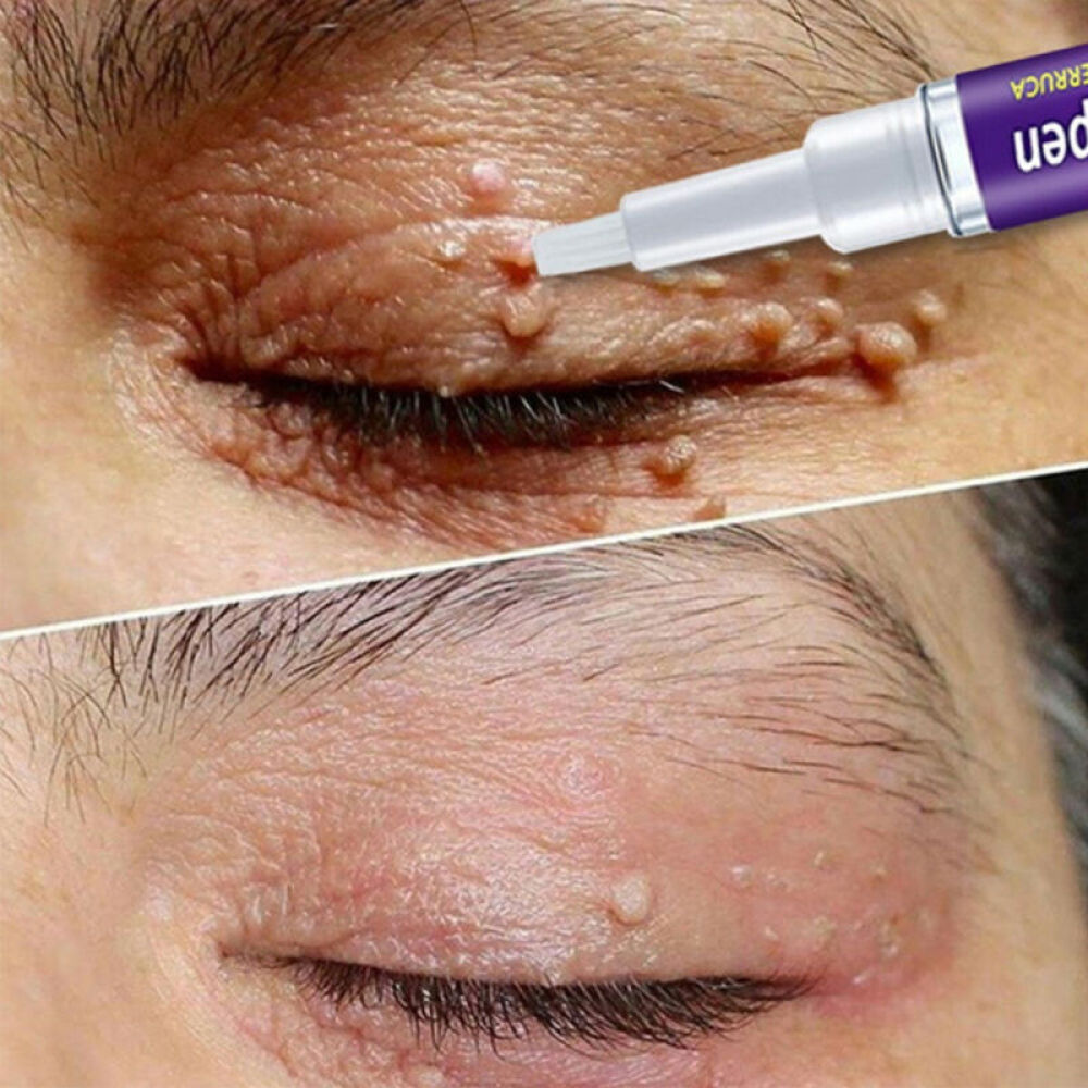 Wart & Skin Tag Remover Pen - Painless, Pimple & Mole Removal Device